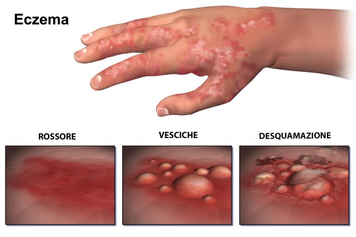 eczema che cose cause sintomi e cure