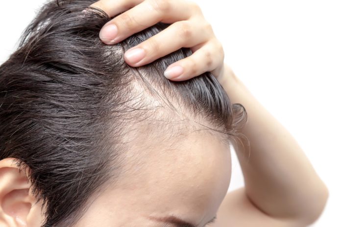 Alopecia: tipologie, cause, rimedi e possibili cure