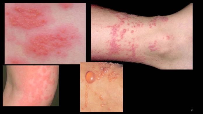 Dermatite: che cos'è, sintomi, tipologie, cause e come diagnosticarla