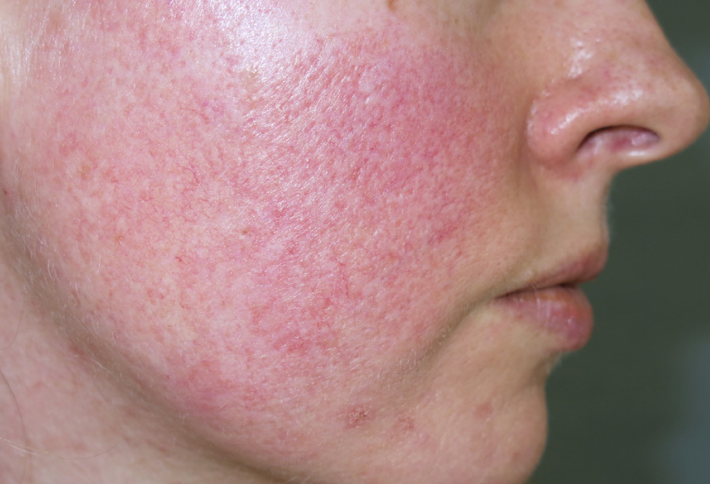 acne rosacea pictures