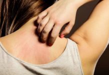 Dermatite Allergica: che cos'è, sintomi, cause e come diagnosticarla