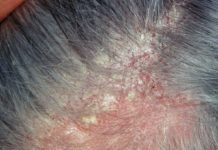 Dermatite Seborroica: che cos'è, sintomi, cause e come diagnosticarla