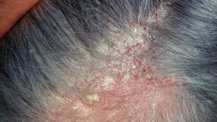 Dermatite Seborroica: che cos'è, sintomi, cause e come diagnosticarla