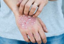 Dieta per la Dermatite: che cos'è, come funziona e cosa mangiare