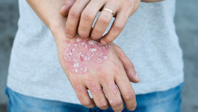 Dieta per la Dermatite: che cos'è, come funziona e cosa mangiare