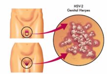 Herpes Genitale: che cos'è, sintomi, diagnosi e possibili cure