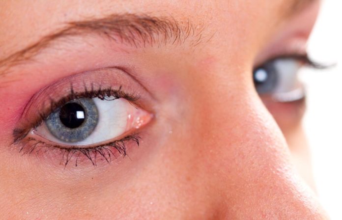 Herpres Oculare: che cos'è, sintomi, diagnosi e possibili cure