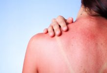 Dermatite Polimorfa Solare: che cos'è, sintomi, cause e come diagnosticarla