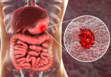Ulcera: che cos'è, cause, sintomi, diagnosi e possibili cure