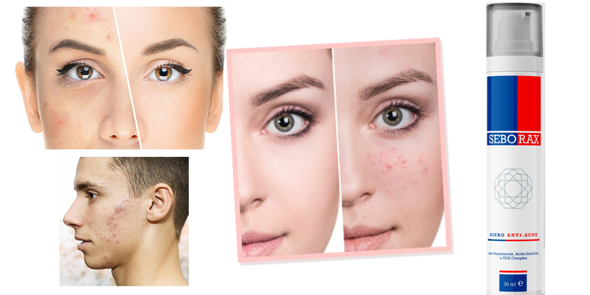 trattamenti viso acne