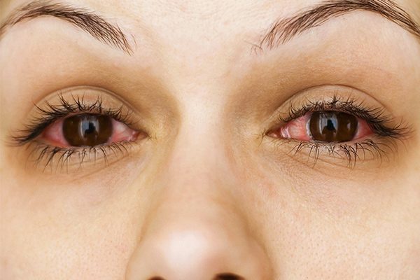 Occhi Arrossati: cosa sono, sintomi, cause e possibili cure