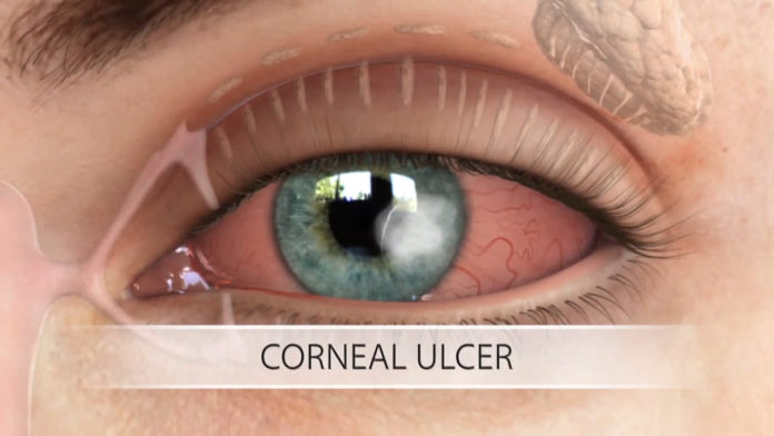 Ulcera corneale: che cos'è, sintomi, cause, diagnosi e possibili cure