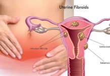 Fibroma Intramurale: che cos'è, cause, sintomi, diagnosi e possibili cure