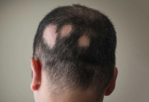Alopecia Areata: che cos'è, cause, sintomi, possibili cure e controindicazioni
