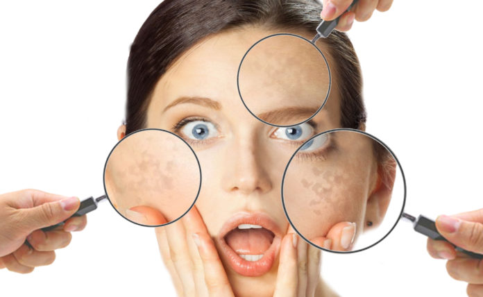 Macchie della pelle (Lentigo Solari): cosa sono, cause, sintomi, diagnosi e possibili cure
