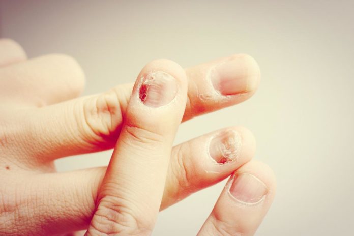 Micosi delle unghie: che cos'è, sintomi, cause e possibili cure