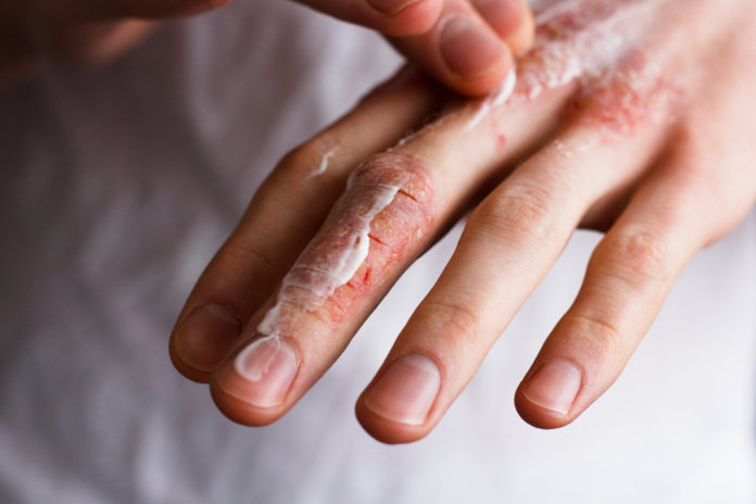 Ragadi alle dita delle mani: cosa sono, sintomi, cause e possibili cure