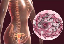 Vaginosi Batterica : che cos’è, sintomi, cause, diagnosi e possibili cure