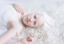 L'Albinismo: che cos'è, cause, diagnosi e tipologie