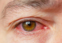 Uveite dell'occhio: che cos'è, cause, sintomi, diagnosi e possibili cure