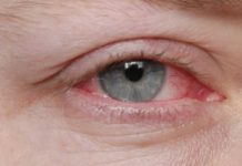 Cheratite dell’occhio: che cos'è, cause, sintomi, diagnosi e possibili cure