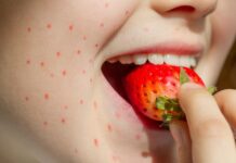 Allergie Crociate: cosa sono, cause, sintomi, diagnosi e possibili cure